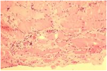 Histopathology of dermatomyositis showing inflamma