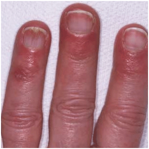http://www.e-rheumatology.gr/sites/default/files/RAYNAUD-Chilblain-hands.gif