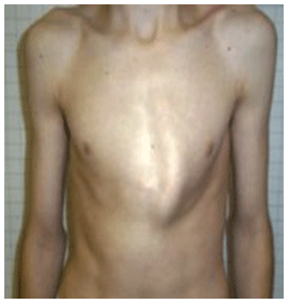 http://www.e-rheumatology.gr/sites/default/files/MARFAN-Pes-excavatum.gif