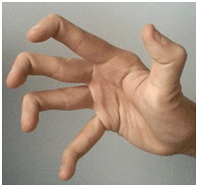 http://www.e-rheumatology.gr/sites/default/files/MARFAN-Hypermobility-Fingers_1.gif