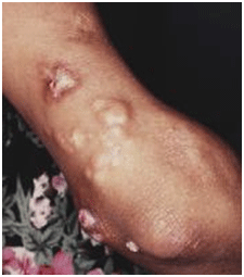 Calcinosis caused by dermatomyositis in childhood 