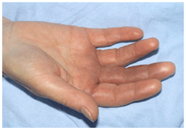 http://www.e-rheumatology.gr/sites/default/files/RAYNAUD-Blue-fingers-syndrome-02.gif